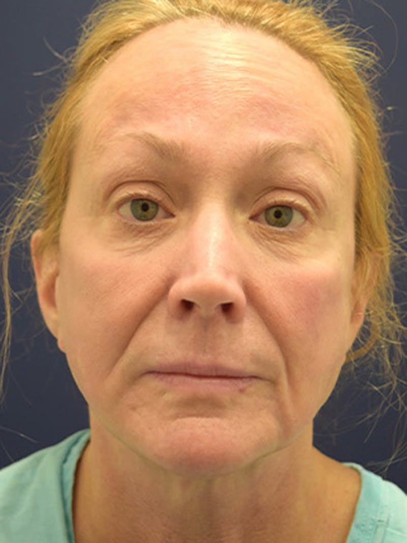 Facelift Before & After Gallery - Patient 174146445 - Image 1