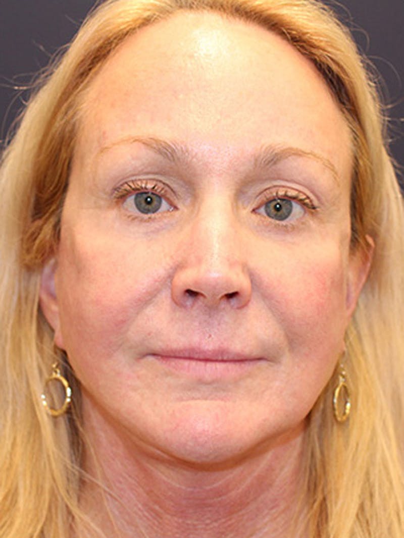 Facelift Before & After Gallery - Patient 174146445 - Image 2