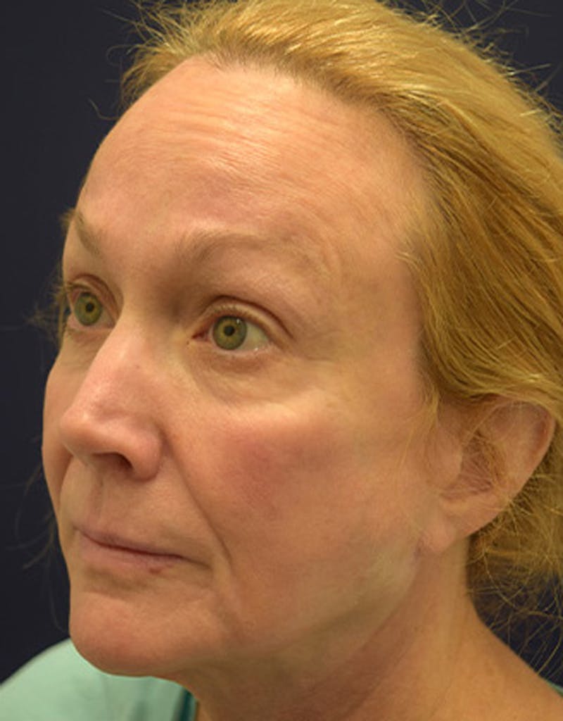 Facelift Before & After Gallery - Patient 174146445 - Image 3