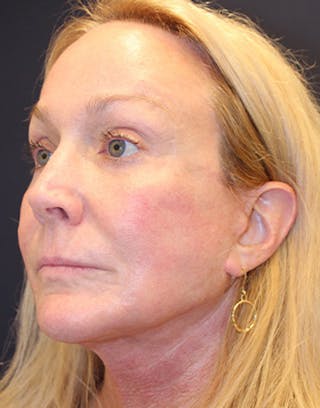 Facelift Before & After Gallery - Patient 174146445 - Image 4
