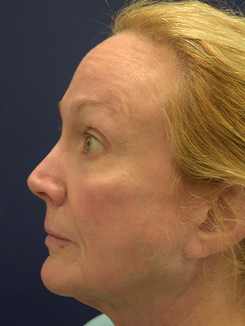 Facelift Before & After Gallery - Patient 174146445 - Image 5