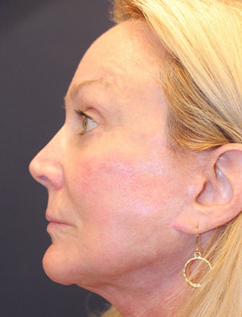 Facelift Before & After Gallery - Patient 174146445 - Image 6
