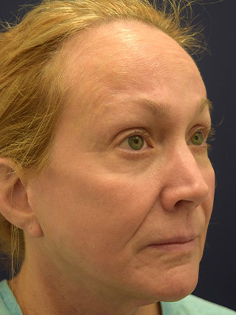 Facelift Before & After Gallery - Patient 174146445 - Image 7