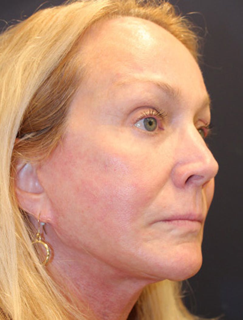 Facelift Before & After Gallery - Patient 174146445 - Image 8