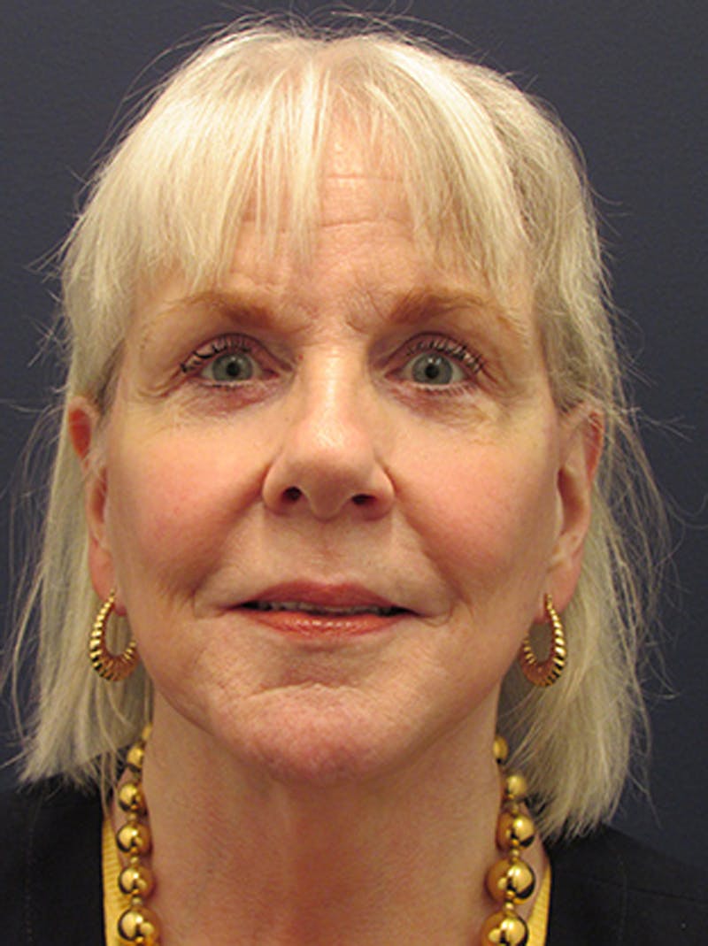 Facelift Before & After Gallery - Patient 174146450 - Image 2