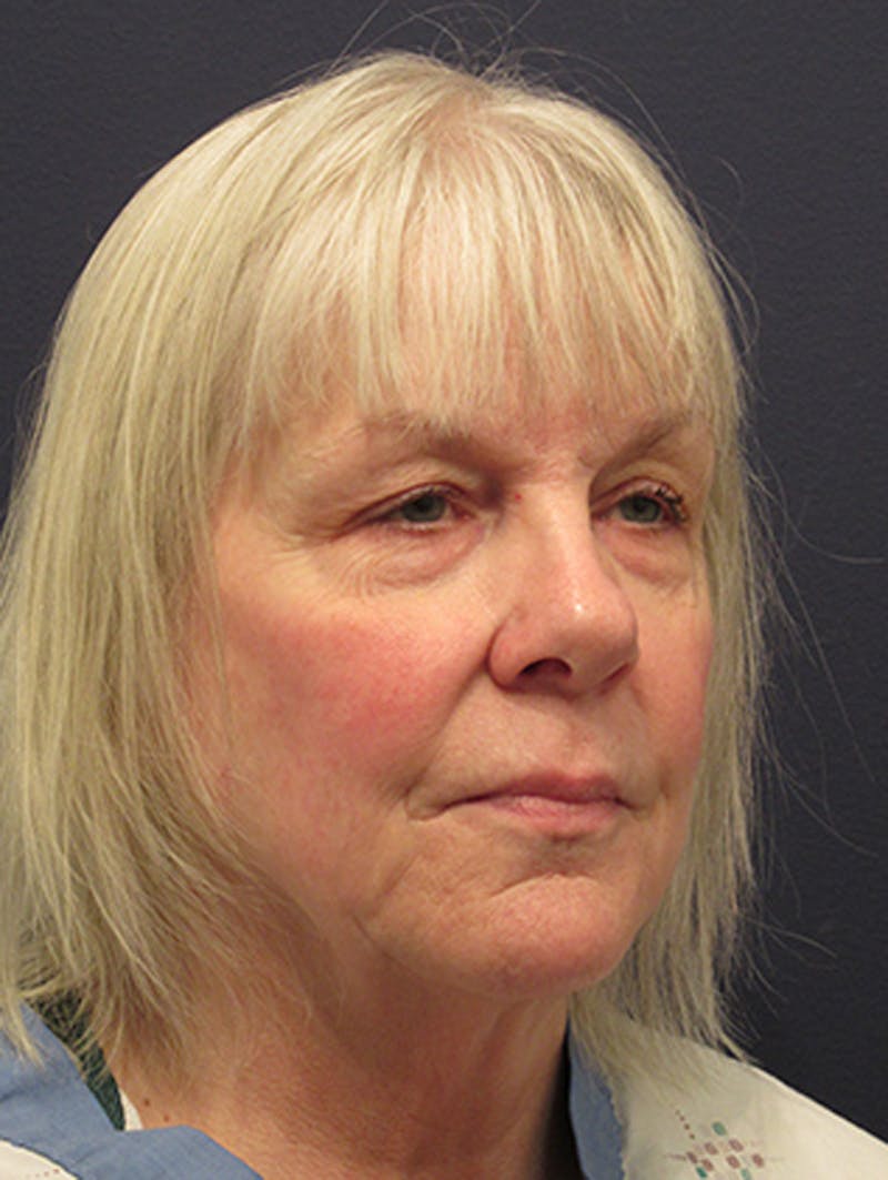 Facelift Before & After Gallery - Patient 174146450 - Image 3