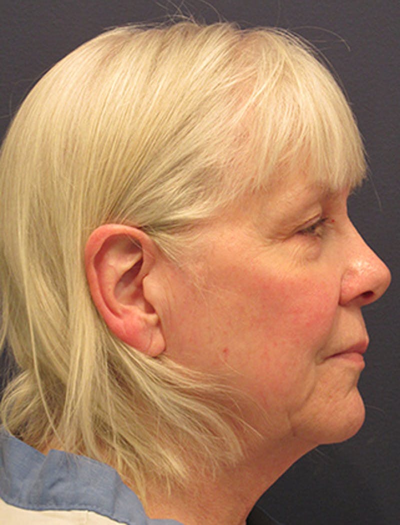 Facelift Before & After Gallery - Patient 174146450 - Image 5