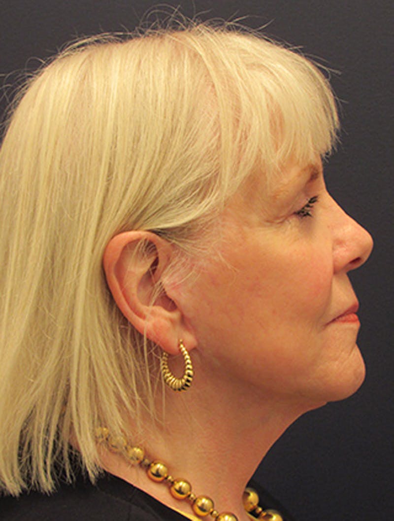 Facelift Before & After Gallery - Patient 174146450 - Image 6