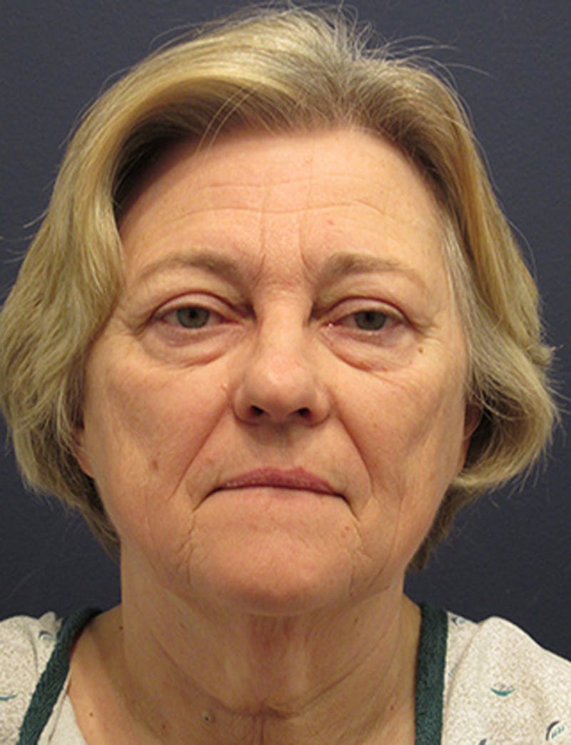 Facelift Before & After Gallery - Patient 174146456 - Image 1