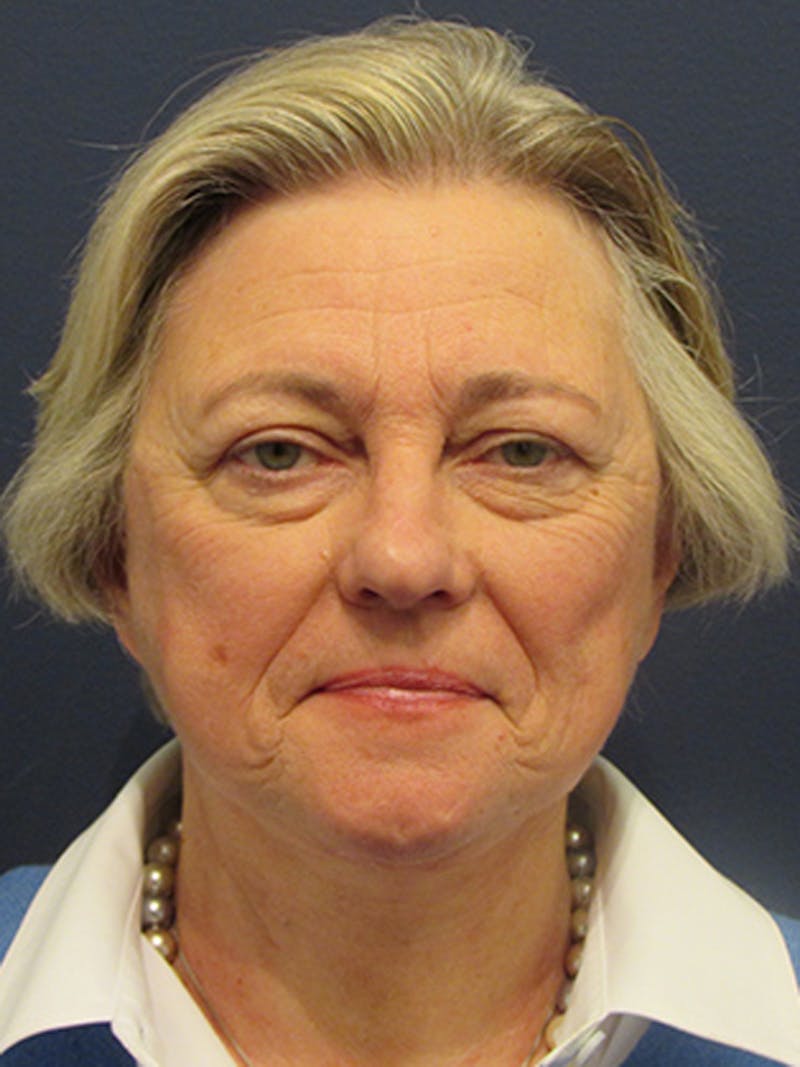 Facelift Before & After Gallery - Patient 174146456 - Image 2