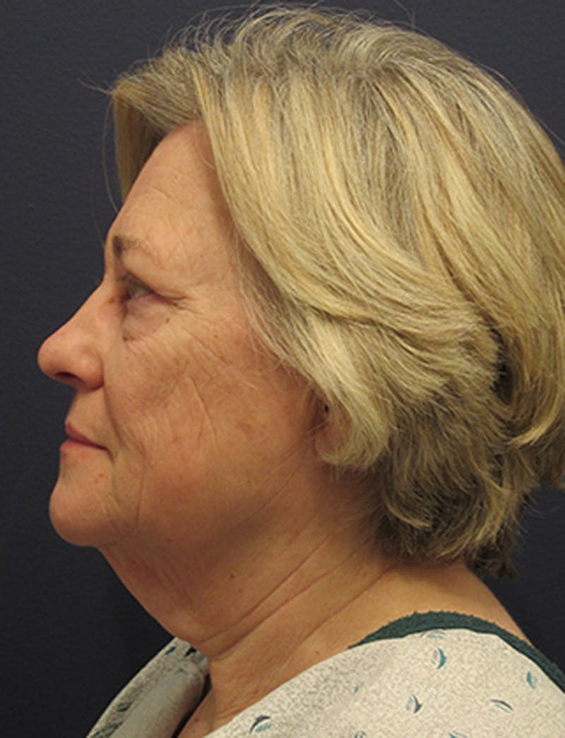 Facelift Before & After Gallery - Patient 174146456 - Image 5
