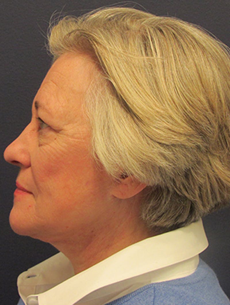Facelift Before & After Gallery - Patient 174146456 - Image 6