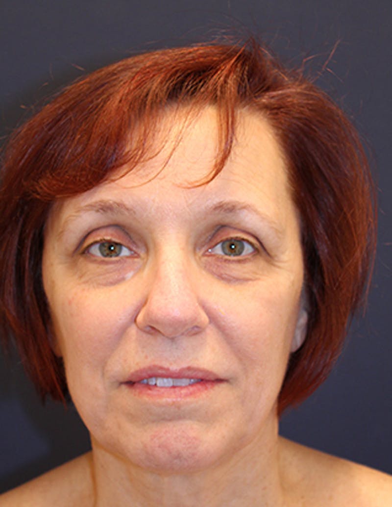 Facelift Before & After Gallery - Patient 174146461 - Image 1