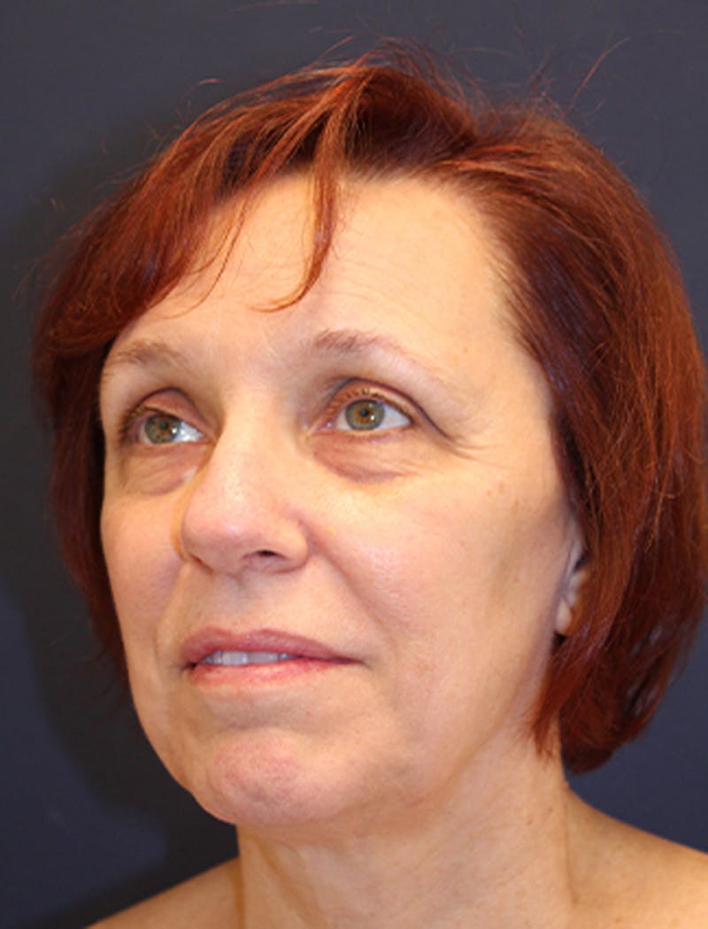 Facelift Before & After Gallery - Patient 174146461 - Image 3