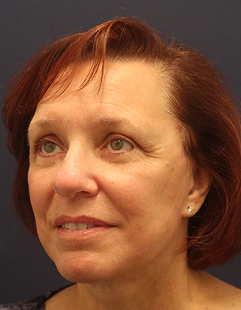 Facelift Before & After Gallery - Patient 174146461 - Image 4