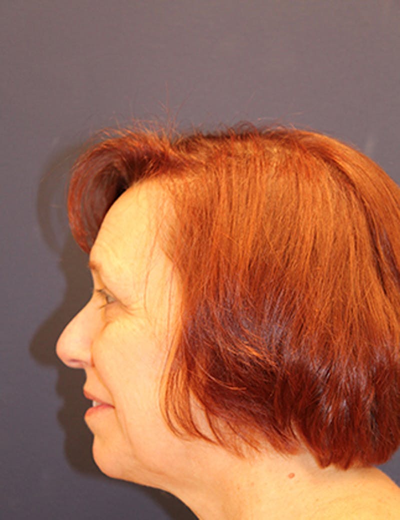 Facelift Before & After Gallery - Patient 174146461 - Image 5