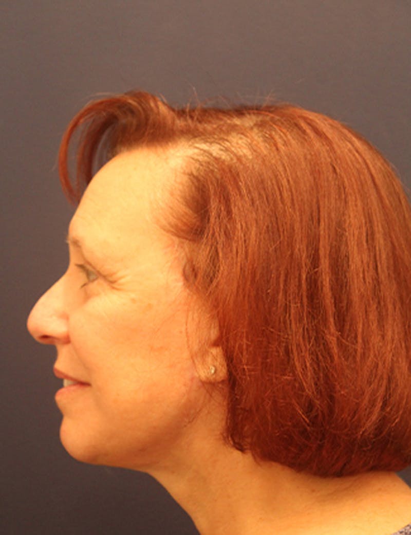 Facelift Before & After Gallery - Patient 174146461 - Image 6