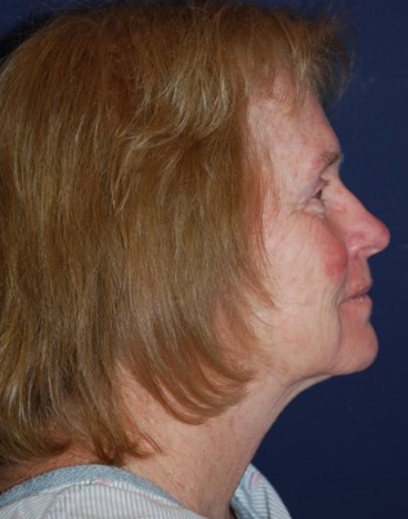 Facelift Before & After Gallery - Patient 174146466 - Image 3