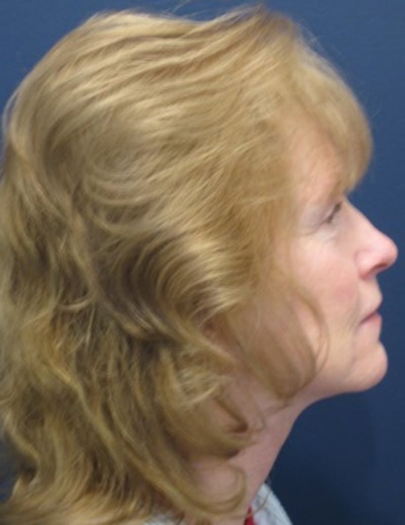 Facelift Before & After Gallery - Patient 174146466 - Image 4