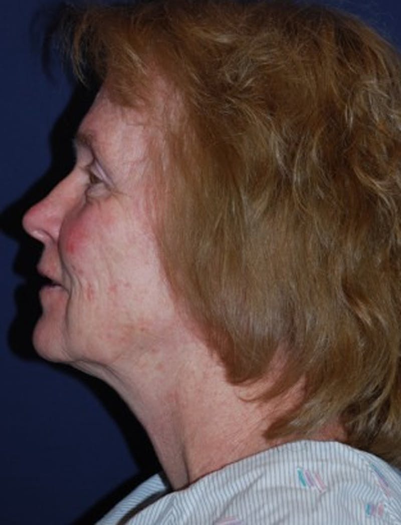 Facelift Before & After Gallery - Patient 174146466 - Image 5