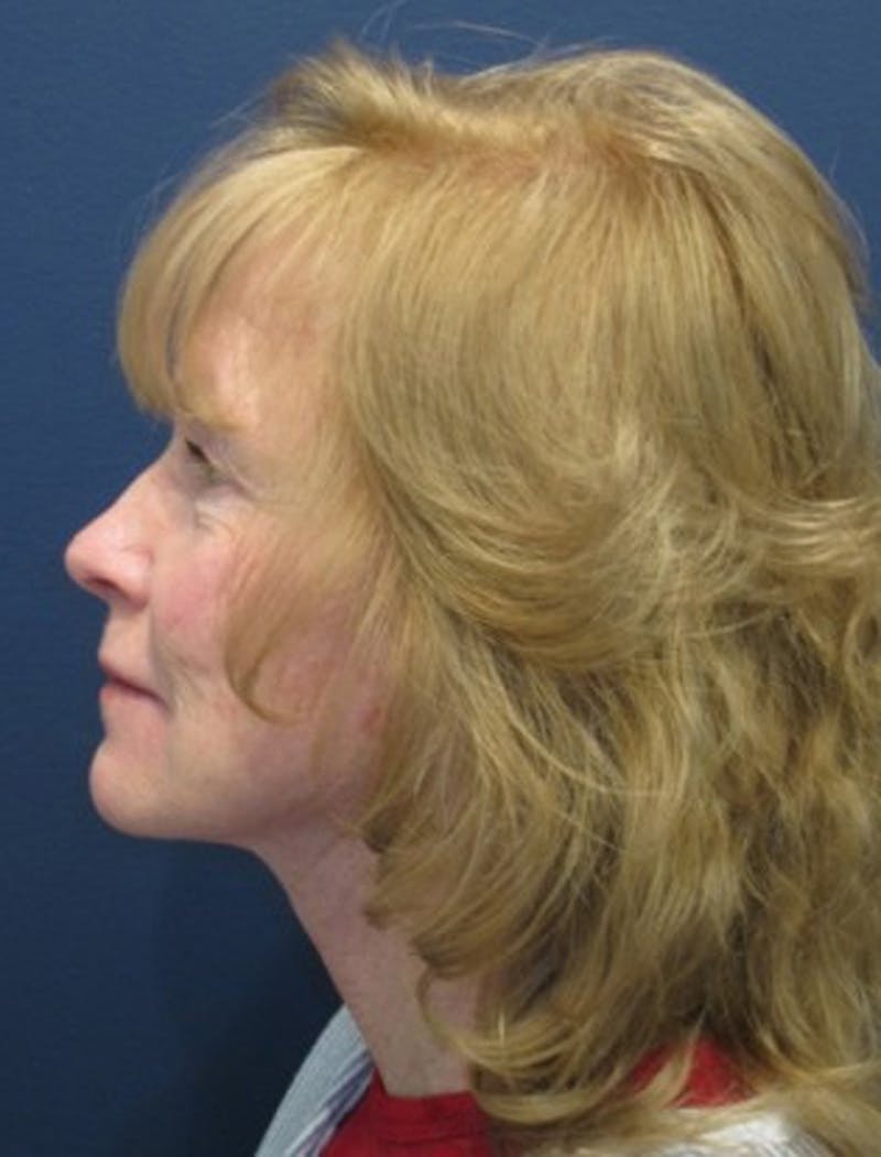 Facelift Before & After Gallery - Patient 174146466 - Image 6