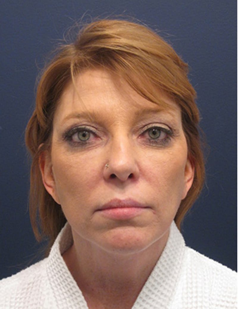 Facelift Before & After Gallery - Patient 174146471 - Image 2