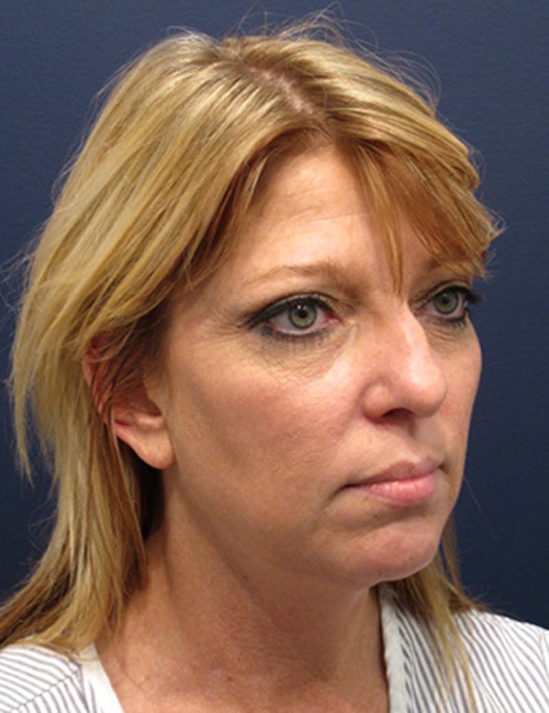 Facelift Before & After Gallery - Patient 174146471 - Image 3