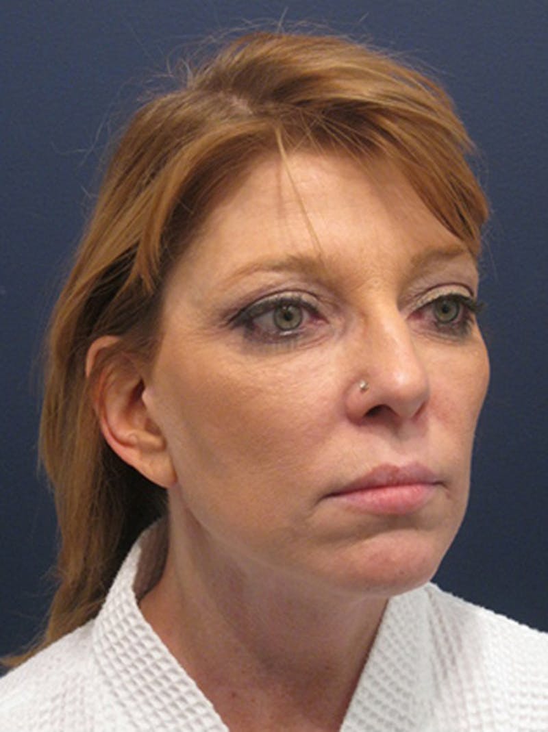 Facelift Before & After Gallery - Patient 174146471 - Image 4