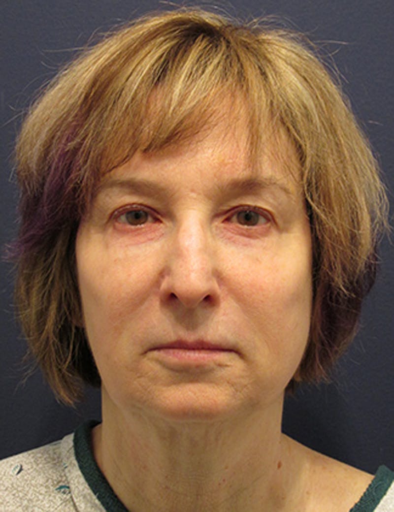 Facelift Before & After Gallery - Patient 174146476 - Image 1