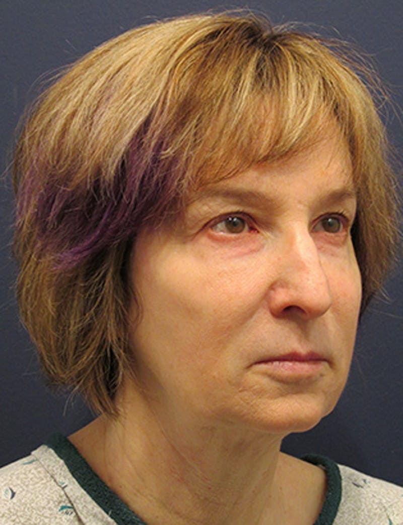 Facelift Before & After Gallery - Patient 174146476 - Image 3