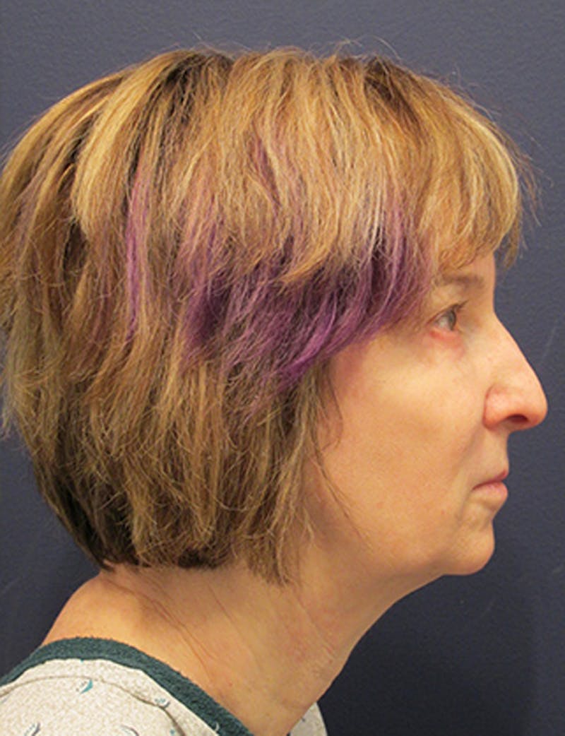Facelift Before & After Gallery - Patient 174146476 - Image 5
