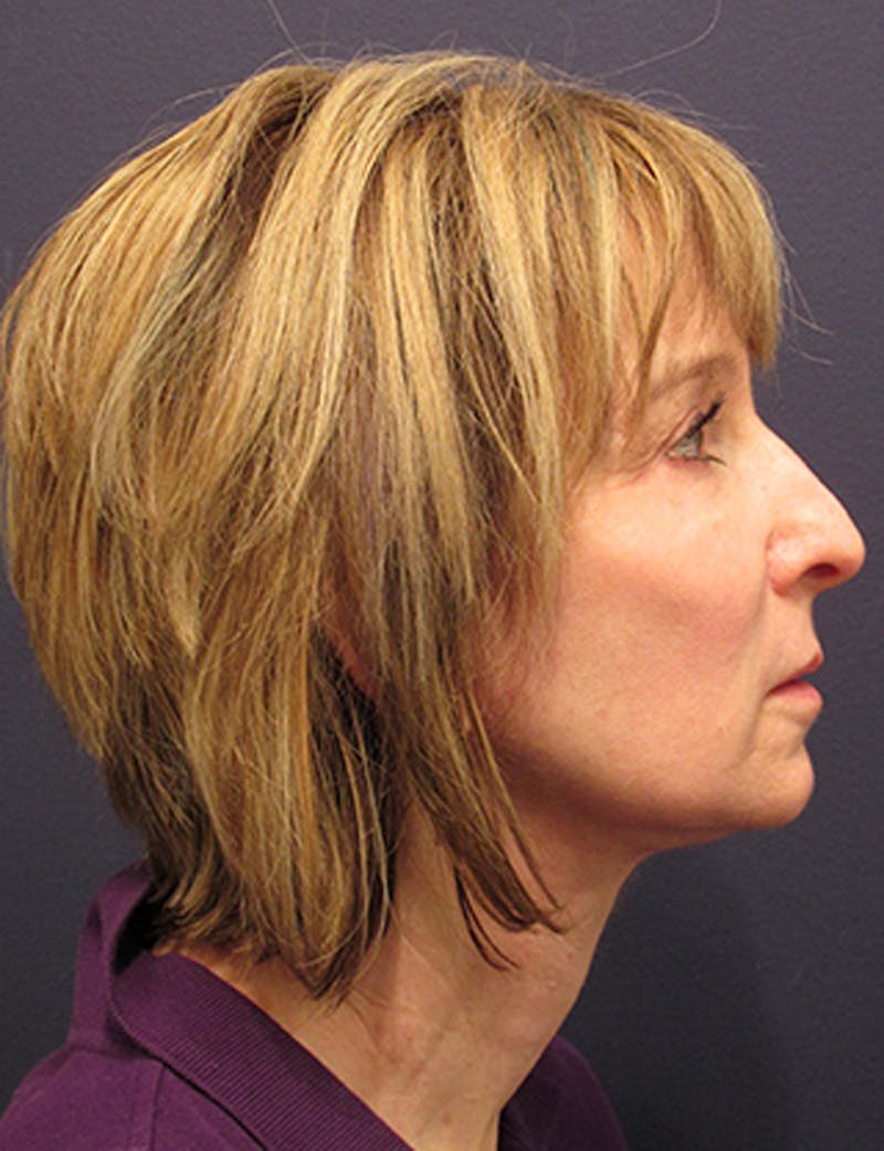 Facelift Before & After Gallery - Patient 174146476 - Image 6