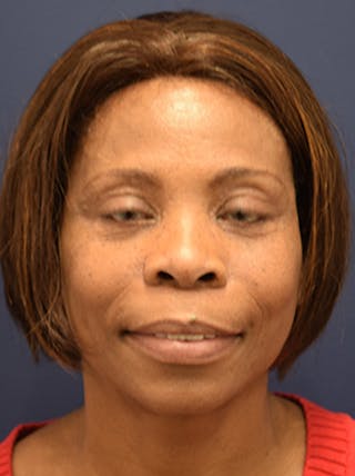 Facelift Before & After Gallery - Patient 174146485 - Image 2