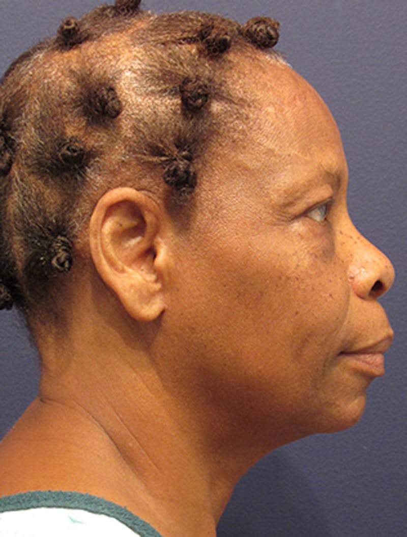 Facelift Before & After Gallery - Patient 174146485 - Image 5