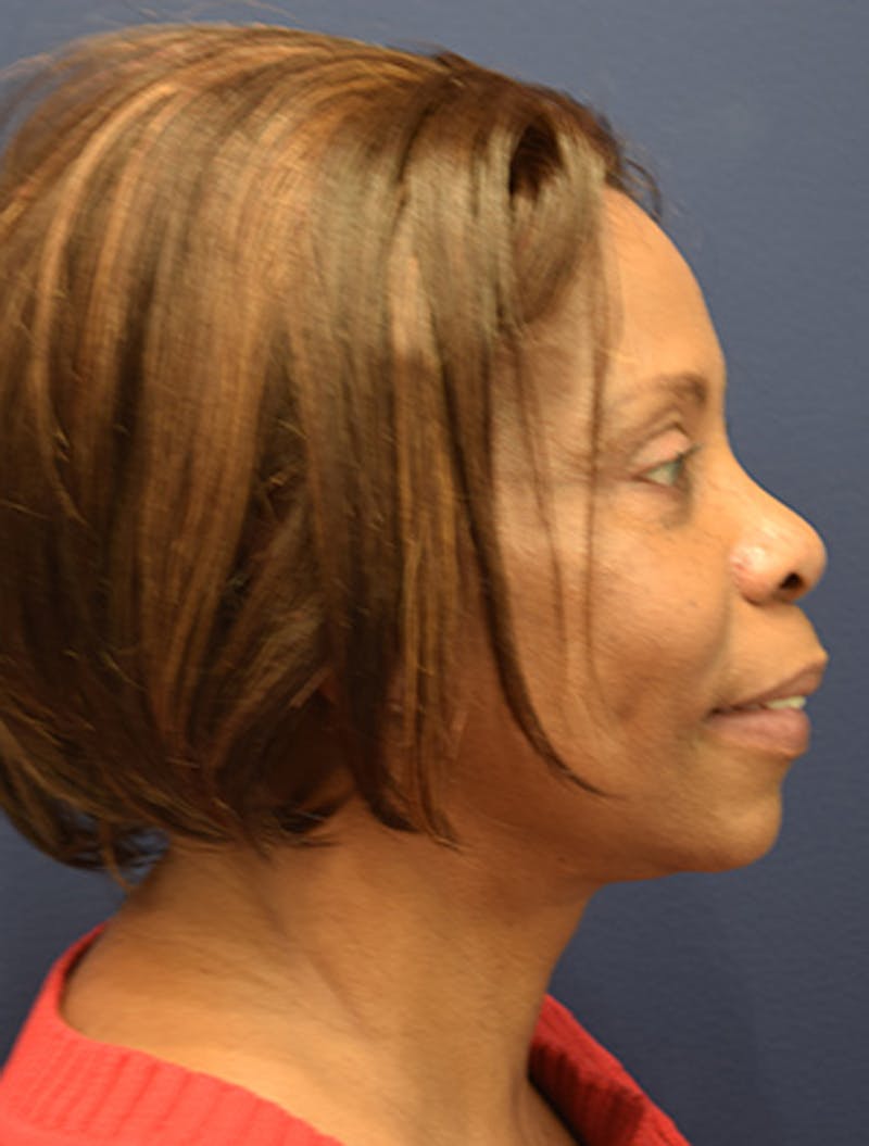 Facelift Before & After Gallery - Patient 174146485 - Image 6