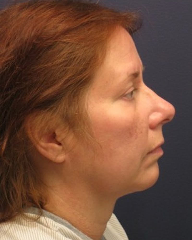 Facelift Before & After Gallery - Patient 174146490 - Image 3