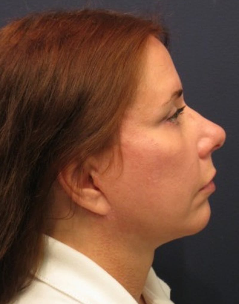 Facelift Before & After Gallery - Patient 174146490 - Image 4