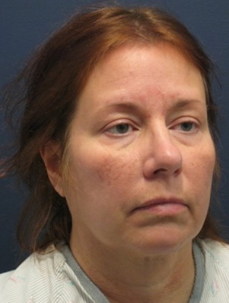 Facelift Before & After Gallery - Patient 174146490 - Image 5