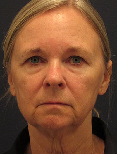 Facelift Before & After Gallery - Patient 174146495 - Image 1