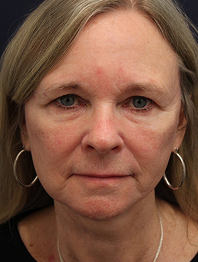Facelift Before & After Gallery - Patient 174146495 - Image 2