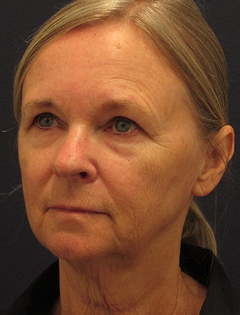 Facelift Before & After Gallery - Patient 174146495 - Image 3