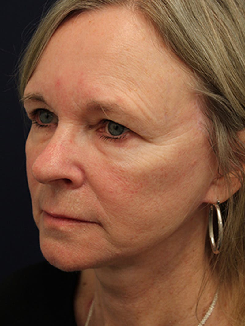 Facelift Before & After Gallery - Patient 174146495 - Image 4