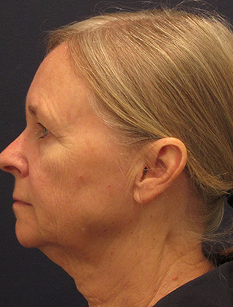Facelift Before & After Gallery - Patient 174146495 - Image 5