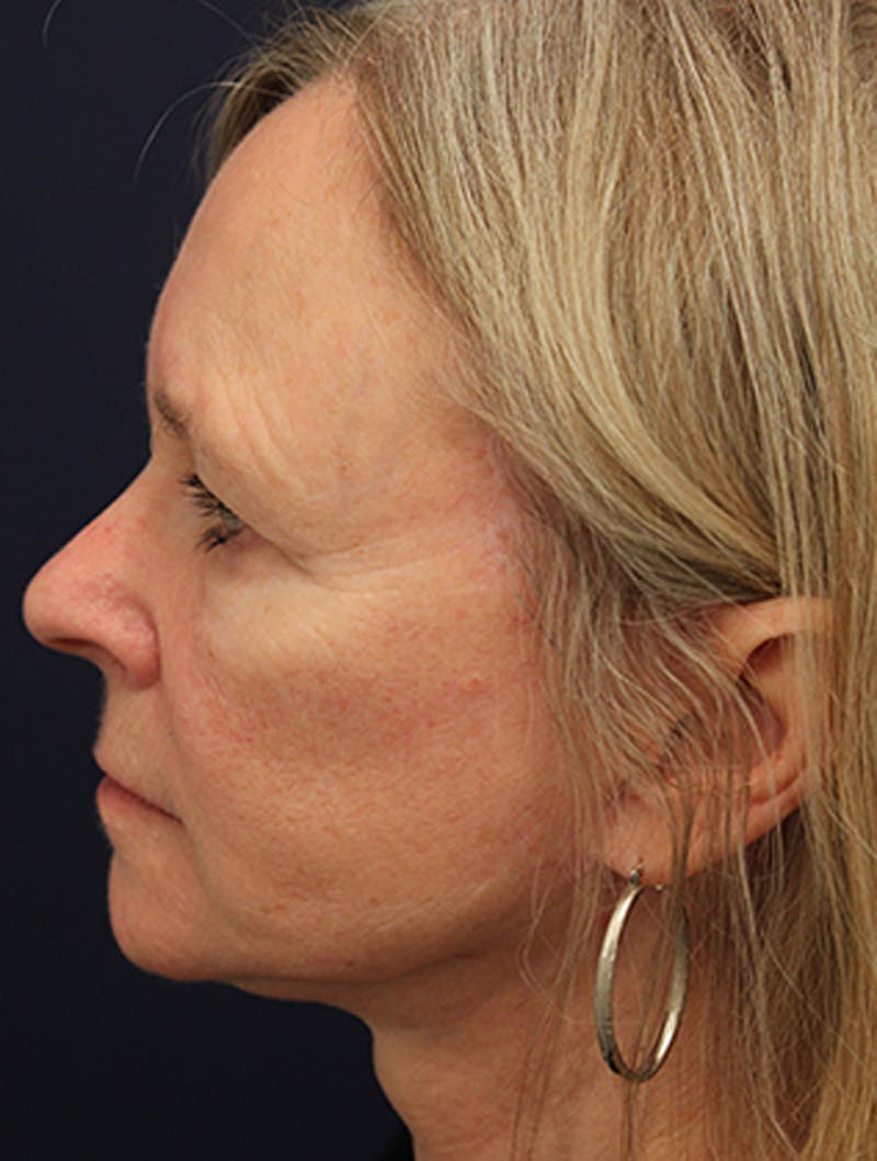 Facelift Before & After Gallery - Patient 174146495 - Image 6