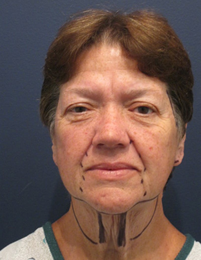 Facelift Before & After Gallery - Patient 174146499 - Image 1