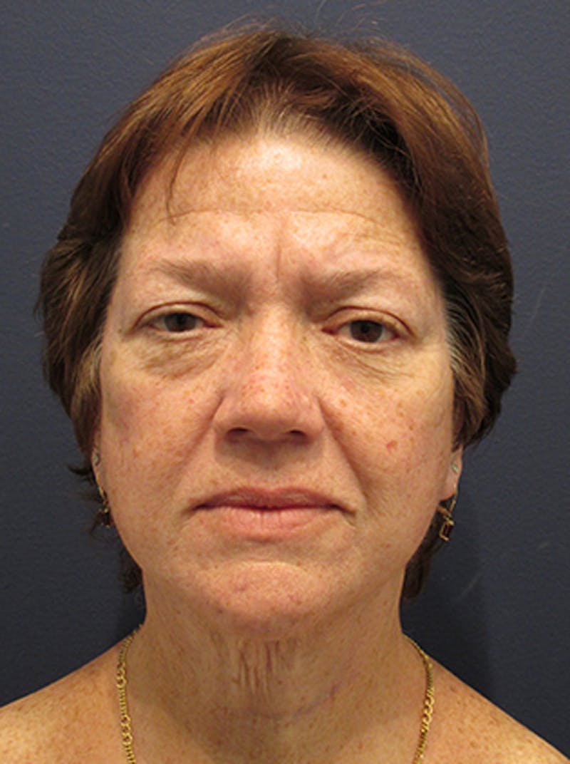 Facelift Before & After Gallery - Patient 174146499 - Image 2