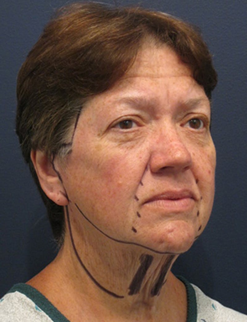 Facelift Before & After Gallery - Patient 174146499 - Image 3