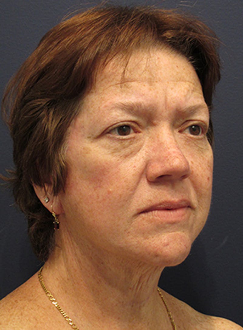 Facelift Before & After Gallery - Patient 174146499 - Image 4