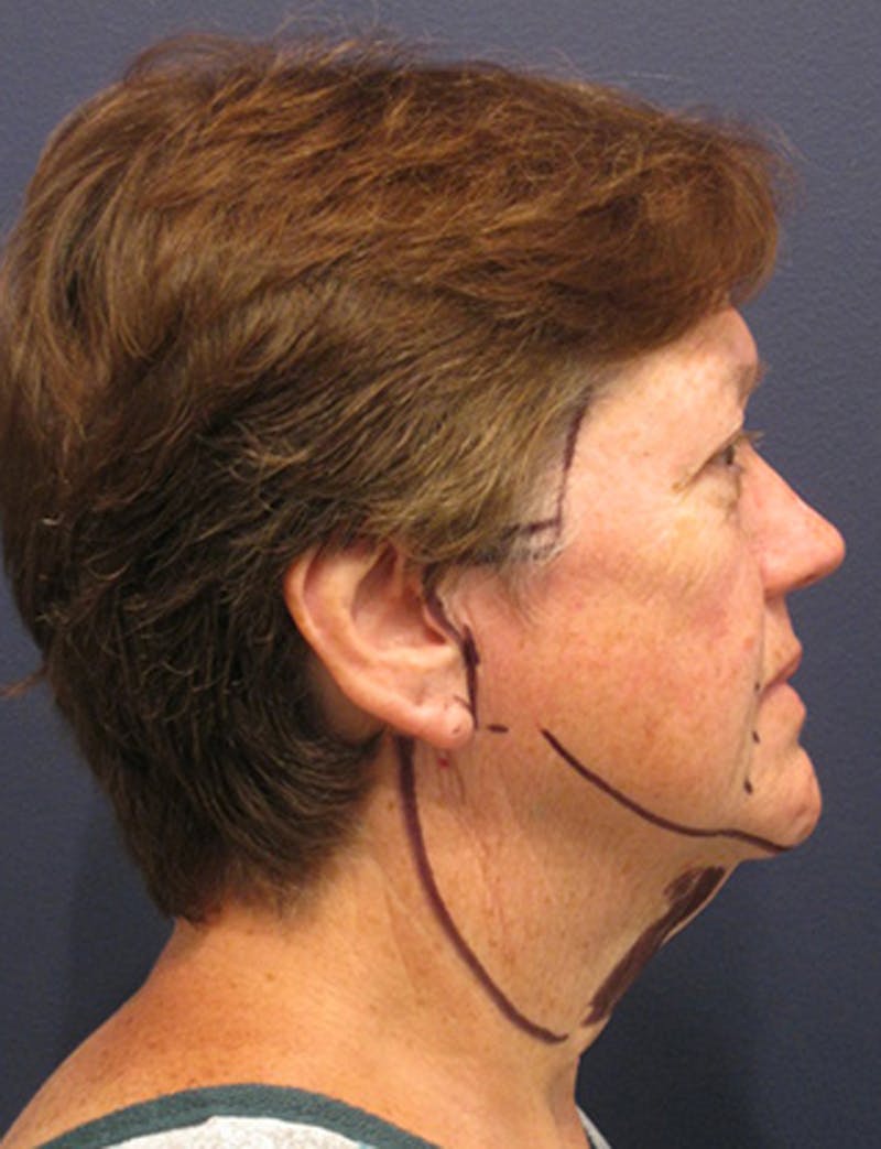 Facelift Before & After Gallery - Patient 174146499 - Image 5