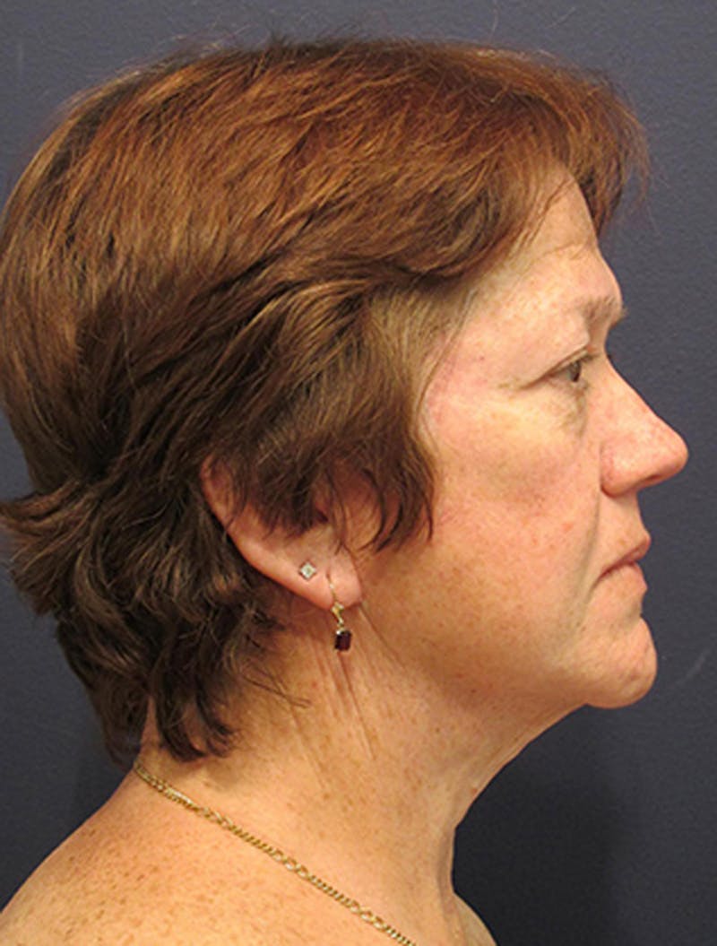 Facelift Before & After Gallery - Patient 174146499 - Image 6